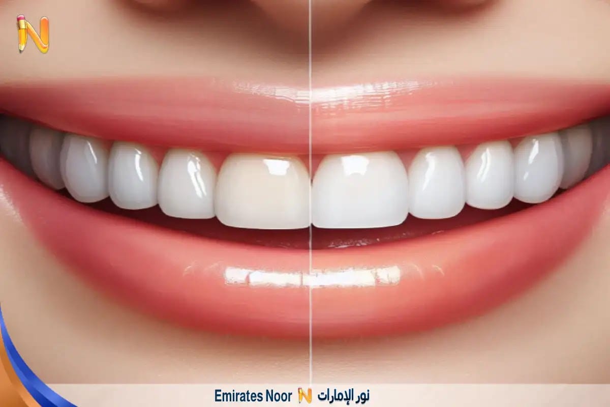 مميزات تجميل الأسنان الأمامية بالفينير